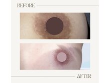 サロンウム(Salon umu)/くすんだ乳頭を綺麗なピンクに