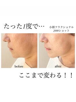 オルネ(ORNE.)/《小顔フラクショナル》