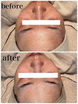 ディオーネ 春日井勝川店(Dione)/顔脱毛+毛穴洗浄