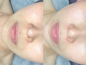 エモーショナル 姫路(Emotional)/ハリ弾力UP【ララピール】