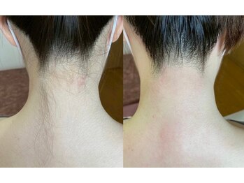 ティンク(Tink)/うなじワックス☆Before→After