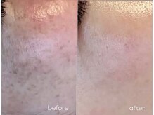 【プラズマニア】透明感あげて内側から輝く！人生変わる肌ケア！