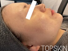 トップスキン 名駅(TOPSKIN)/肌荒れのない健康的なツヤ肌へ☆