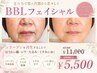 【話題のフェイシャル】最新BBLフェイシャル ¥11000→¥5500