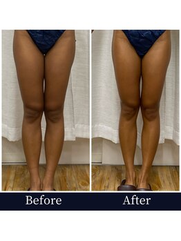 ハリルル 併設 GLケンタ鍼灸整骨院(HARILULU)/ハイパーナイフ　B/Ａ