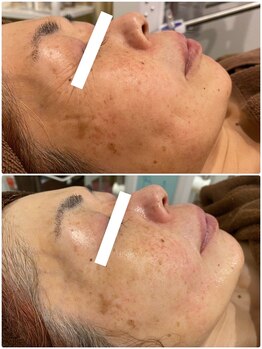 エステサロン ブレス 山形店(BLESS)/フェイシャル結果