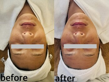 メナードフェイシャルサロン 西五反田/小顔/トーンUP/ハリ・ツヤ