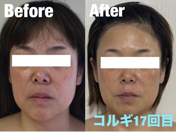 ビーキュート 渋谷北参道店(BE-CUTE)/小顔コルギ17回目 40代