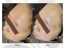 アン ビューティー(ann beauty)/施術1回【症例写真】20代