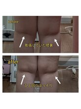 紬(TSUMUGI)/膝周りの厚みや痛みもスッキリ