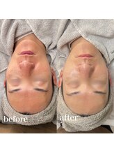 サロンエル(SALON el)/◇肌質改善ピーリング◇