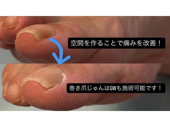 GWも対応!巻き爪の痛み改善