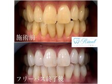 歯のホワイトニング／ビフォーアフター