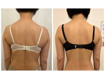 美人バスト 福岡店/バストアップ ◇症例◇