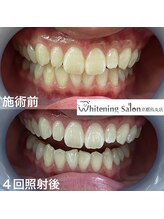 ホワイトニングサロン 京都烏丸店/ホワイトニング施術例　