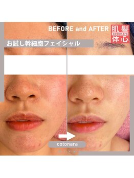 アンナカルナ(AnnaCarna)/赤みのあるお肌質改善にコツあり