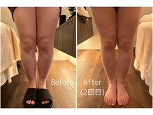 デルタエヌピー63+(δnp63+)/美脚鍼　【小顔/薬院/福岡】