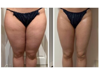 ルナグランデ 心斎橋店(Luna grande.)/最新機器により脂肪撃退