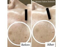 アンティミテ(Intimite)の雰囲気（シミを排出する代謝力を高め、薄くしながら、できないお肌作り）