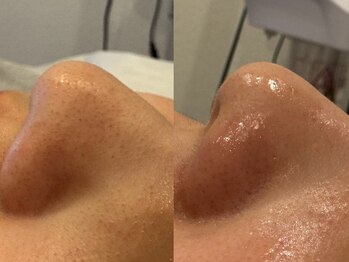 ルノン(Lunon)/毛穴洗浄ハイドロ