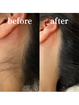 ミノア 大野城店(MINOA)/うなじ脱毛◆ビフォーアフター