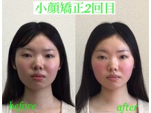 オズ六本木/小顔モニター様＠小顔矯正2回目