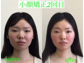 オズ六本木/小顔モニター様@小顔矯正2回目