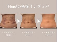 ハネ 自由が丘(Hane)の雰囲気（つらいダウンタイムもサポート[自由が丘/脂肪/吸引/術後/むくみ]）