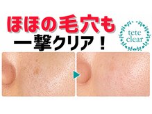 サロンド ケイティ(Salon de Katy)の雰囲気（取れた角栓が見れる！毛穴洗浄/毛穴/毛穴黒ずみ/毛穴ケア/毛穴）