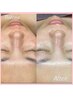 【フェイシャルWAX+アンストレス】産毛・角質ゴソッと除去!うるツヤ水光肌
