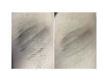 エスケア(S-CARE)/VIOやワキ脱毛も痛みが少ない＊