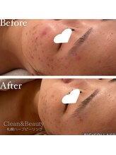 クリーンアンドビューティ 札幌(Clean&Beauty)/札幌初のイロンハーブピーリング