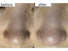 エアル(earu.)/BA|毛穴ケア|ピーリング|高円寺