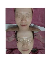 おうちサロン しゅろ/ハーブピーリング　B/A