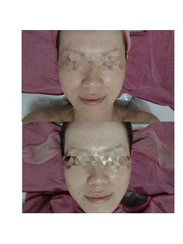 おうちサロン しゅろ/ハーブピーリング　B/A