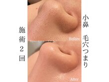 ビジュープラス 水戸店(Bijou+)/鼻の黒ずみ改善