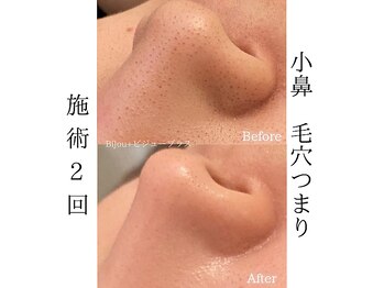 ビジュープラス 水戸店(Bijou+)/鼻の黒ずみ改善