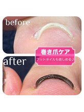 ガーデン 鹿沼店(garden)/巻き爪ケアしながらフットネイル