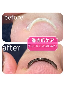 ガーデン 鹿沼店(garden)/巻き爪ケアしながらフットネイル