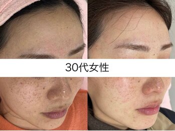 シミケア専門店 SAKURA 平塚店/30代後半　8回目の写真