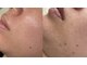 カナエル ビューティーサロン(Canael Beauty salon)の写真/結果重視！大人気のプロセルで毛穴、シミしわ、たるみ、凸凹肌などのあらゆるお肌悩みをスピード改善