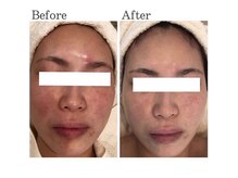 ハイケア グラン ギンザ(HYCARE GRAND GINZA)/日本ーの肌改善サロン実力/銀座