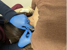 げんき堂鍼灸整骨院 イオン新潟西/鍼施術