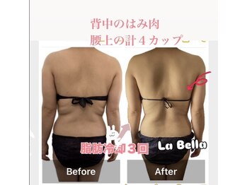 ラベージャ(La Bella)/脂肪冷却