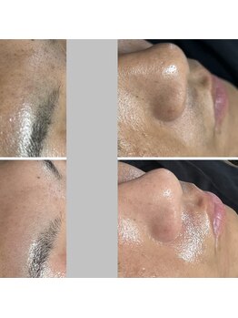 シャイニー(SHINY)/韓国肌管理　ダクトピール