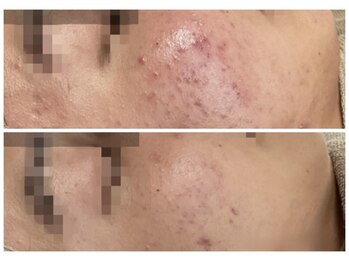 ハリスキンラボ(Hari.Skin.Lab)/ビフォーアフター