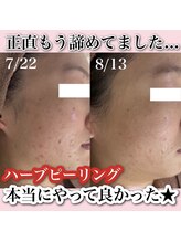 アルムダアクア 天王寺店(Aleumda AQUA)/ハーブピーリング/大阪/天王寺