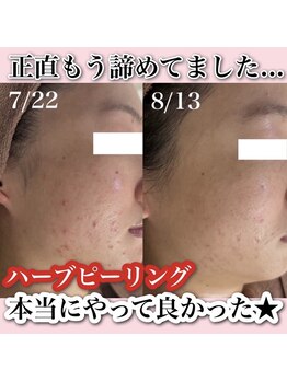 アルムダアクア 天王寺店(Aleumda AQUA)/ハーブピーリング/大阪/天王寺