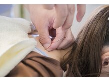 トキハナ アンド アマト(AMATO)/◆施術風景（鍼）