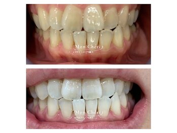 モンシェリ 広島店(Mon Cheri)/ホワイトニングBefore→After